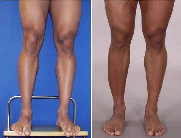 Estetica Europe  Curved Lower Legs and Calf Implants - ro