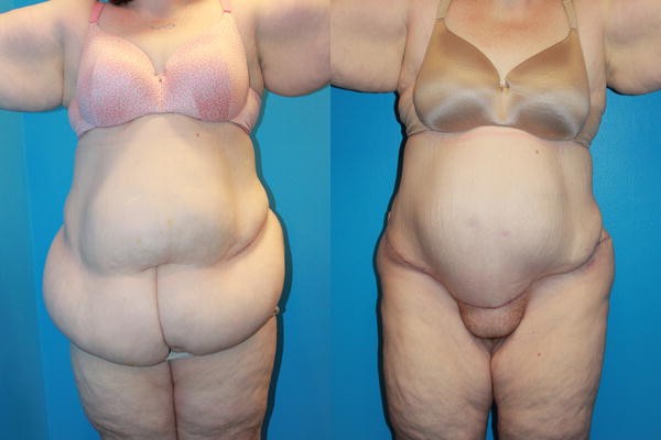 Panniculectomy in patients with super obesity
