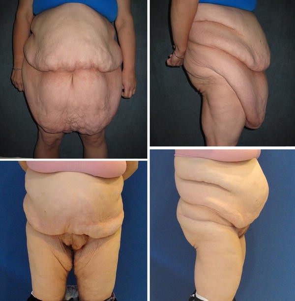 Surgical Management of the Giant Pannus: Indications, Strategies, and  Outcomes