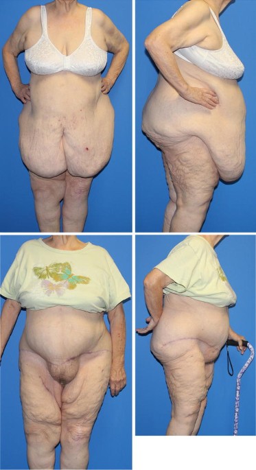 Surgical Management of the Giant Pannus: Indications, Strategies