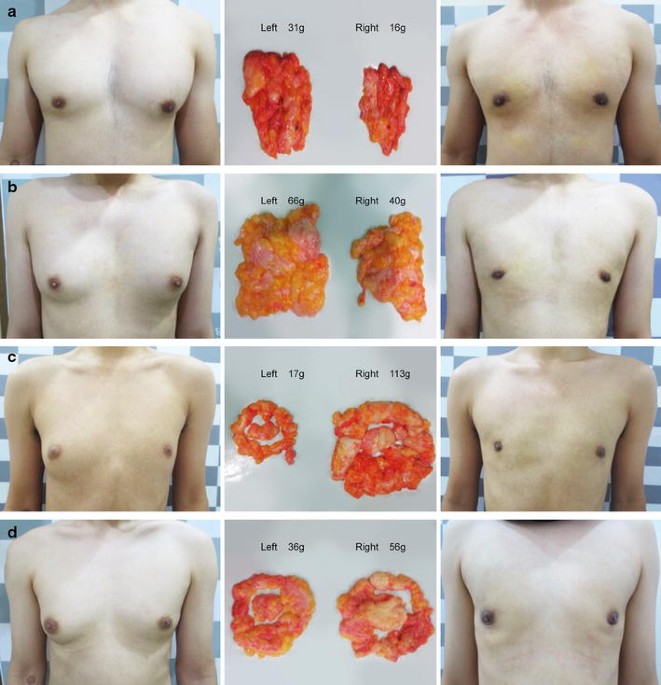 Asymmetrical, Tubular and Accessory Breasts - Kauvery Hospital