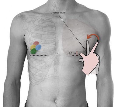 Shape, Position and Dimension of the Nipple Areola Complex in the Ideal  Male Chest: A Quick and Simple Operating Room Technique