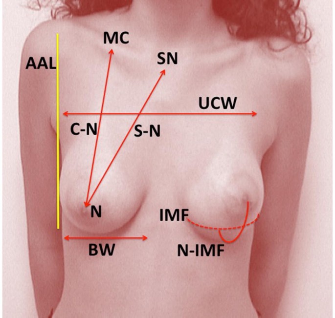 Artist's depiction of the breast ptosis grading system proposed by