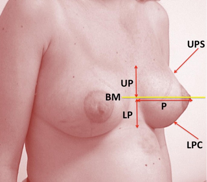 Metrics of the Aesthetically Perfect Breast