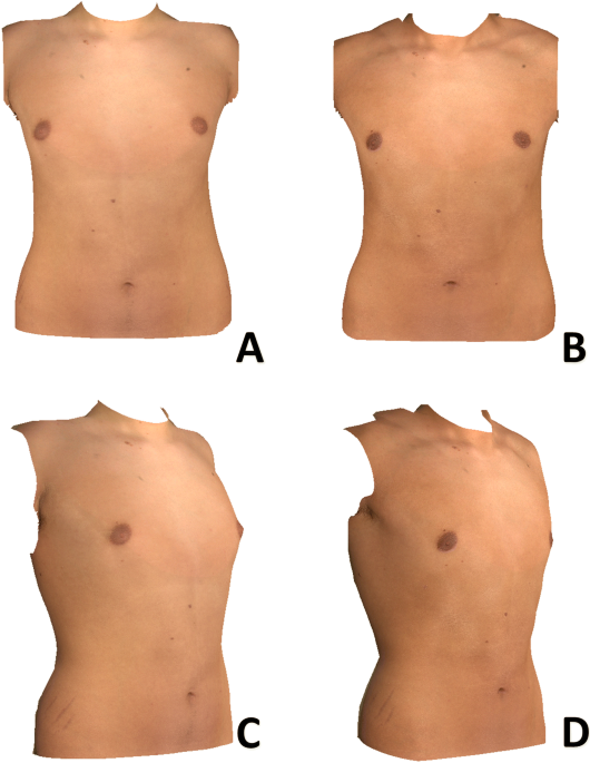 Increase apparent penile length by cryolipolysis in the reduction