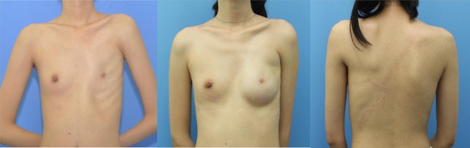 Breast Reconstruction in Poland Syndrome Patients with Latissimus