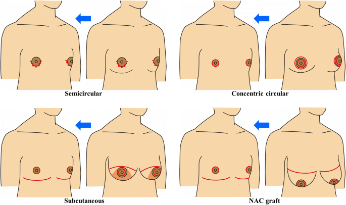 Nipple-Areolar Complex Position in Female-to-Male Transsexuals After  Non-skin-excisional Mastectomy: A Case–Control Study in Japan