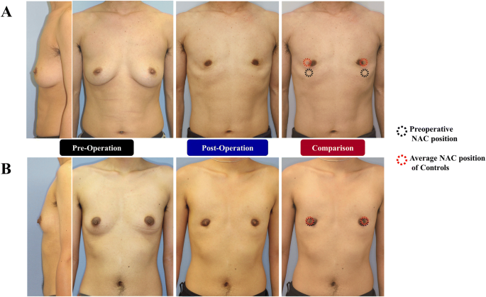 Nipple-Areolar Complex Position in Female-to-Male Transsexuals