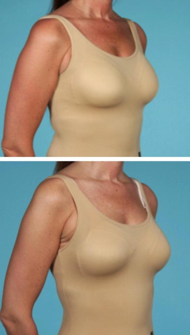 Anatomical Breast Augmentation