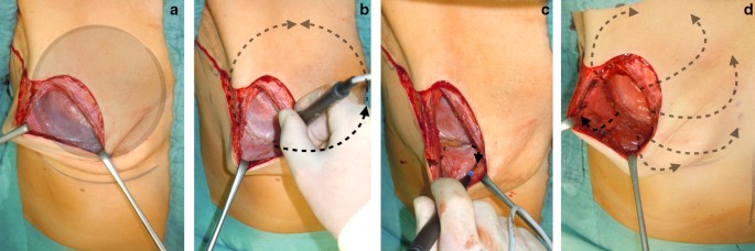 Ruptured Silicone Gel Implant