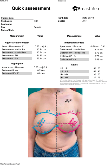 Ideal breast anthropometric indexes used as reference for surgery