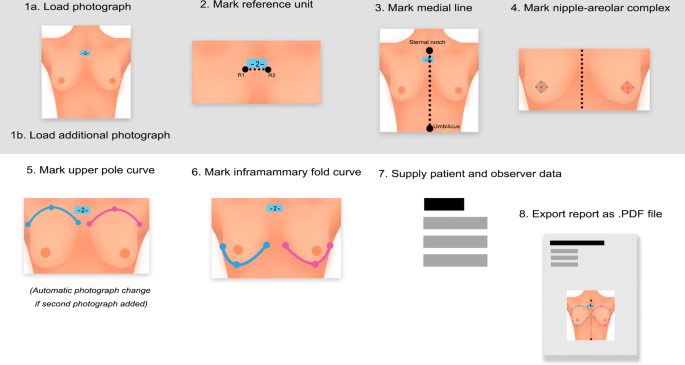 A New Tool for Breast Anthropometric Measurements: Presentation