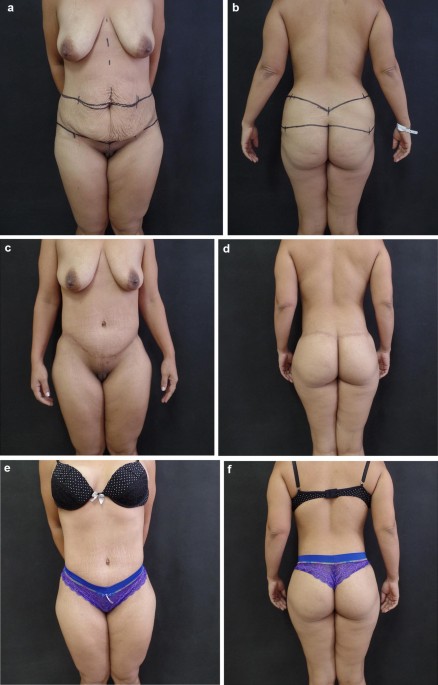 Lower Body Lift After Bariatric Surgery: 323 Consecutive Cases