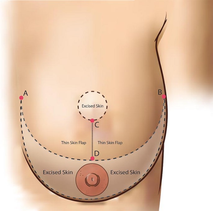 The Aesthetically Ideal Position of the Nipple–Areola Complex on the Breast