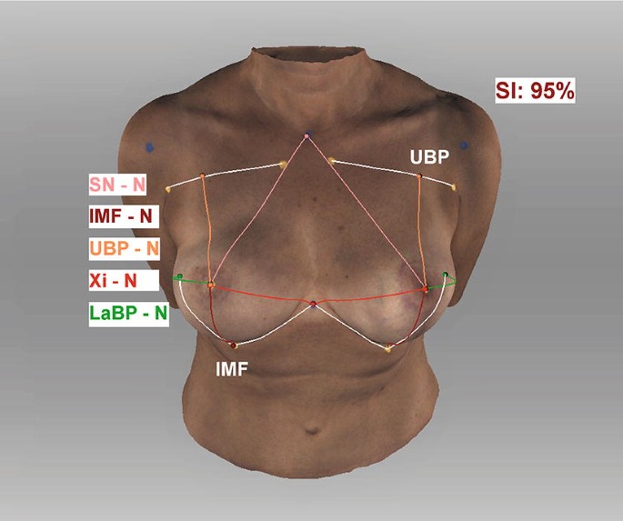 A Novel Method of Outcome Assessment in Breast Reconstruction