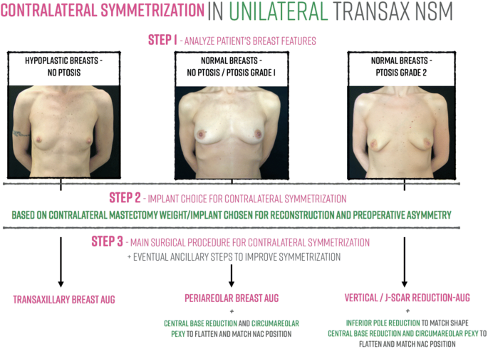 Endoscopic nipple sparing mastectomy with immediate implant-based
