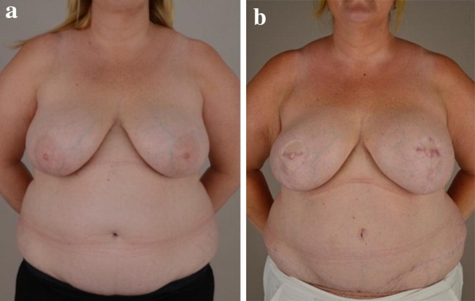 Invited Discussion on: Fat Necrosis After DIEP Flap Breast Reconstruction:  A Review of Perfusion-Related Causes