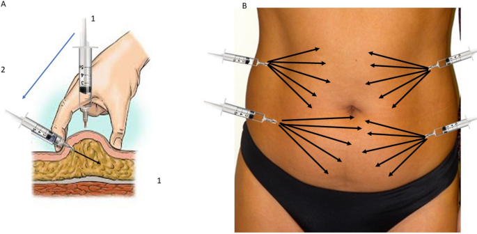 lipo-c subcutaneous injection A New Treatment for Local Adiposity with Ascorbic Acid and  Ascorbyl-Palmitate Solution: Clinical and Histological Study | Aesthetic  Plastic Surgery