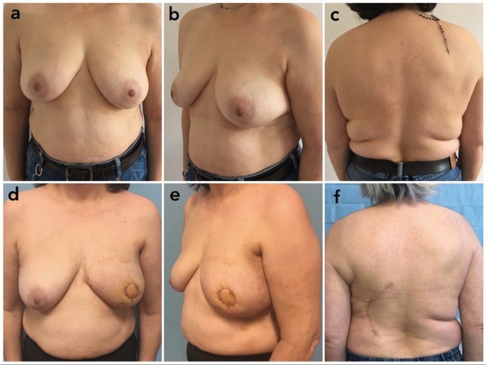 AAPS - Autologous Breast Augmentation With Incision Free Flaps