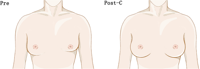 Inverted Nipples Definition – BirthForMen
