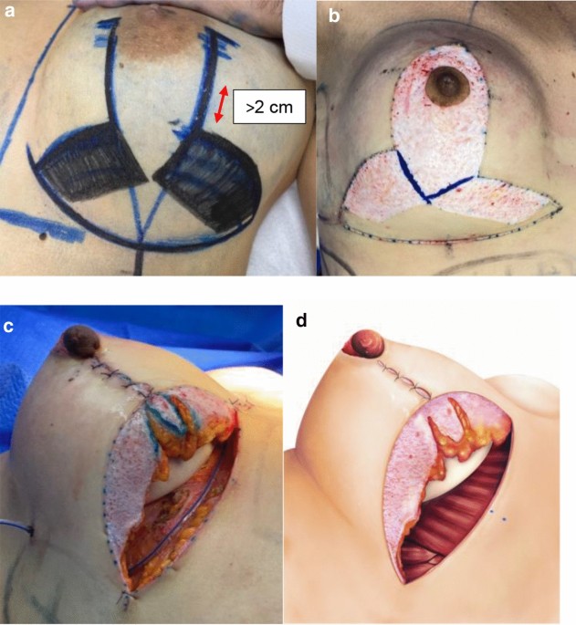 Mastopexy with an Implant and the Making of a Horizontal Flap of the Upper  Pedicle, Simulating an Internal Bra