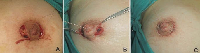 Inverted Nipple Repair - Farber Plastic Surgery