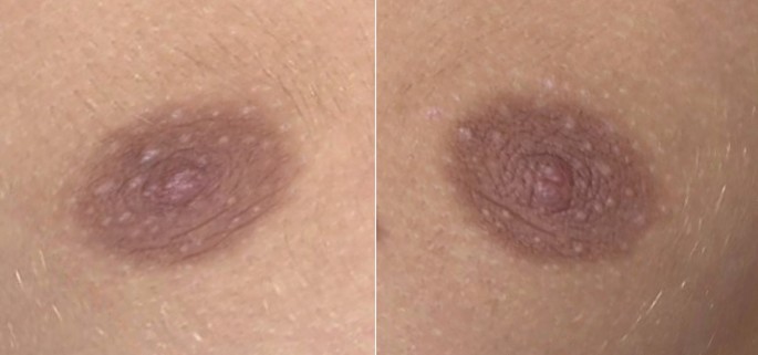 Long-Term Changes in Free Nipple Graft Morphology and Patient
