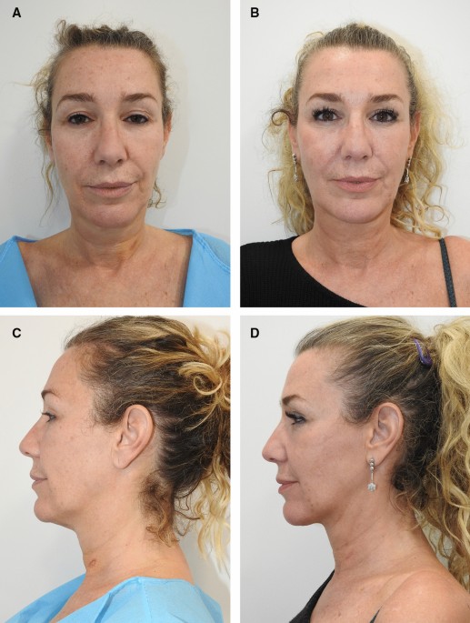 The MICRO-Lift: A Ligaments-Based Anatomic Technique for Lower Face and  Neck Rejuvenation Using Bipolar Radiofrequency.