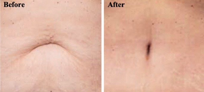 Ideal Male Umbilicus: An Observational Study of Surface Anatomy and  Introduction to the SHAPE Classification | Aesthetic Plastic Surgery
