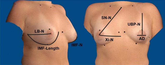 Learn About Breast Asymmetry Correction