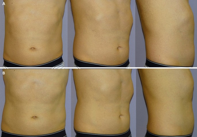 Body Contouring Using a Combination of Pulsed Ultrasound and