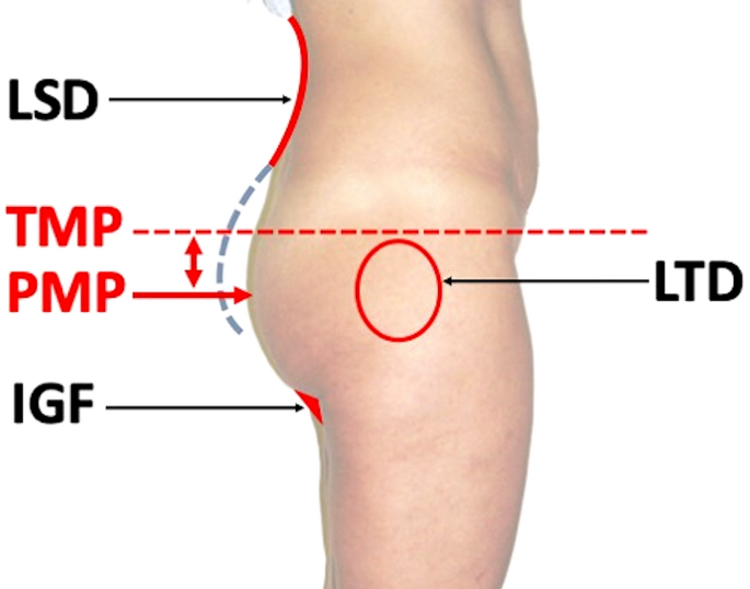 Gluteal Aesthetic Unit Classification