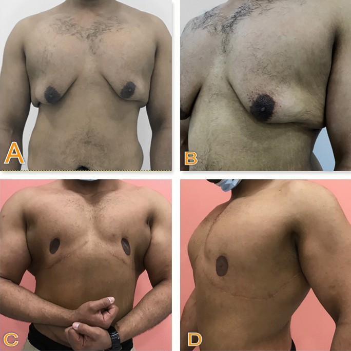 Post Bariatric Male Chest Re-shaping Using L-Shaped Excision