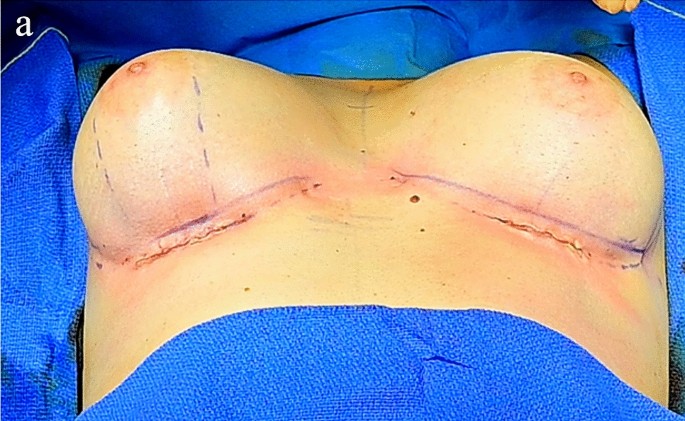 Double-bubble deformity in breast augmentation: correction with  percutaneous barbed sutures