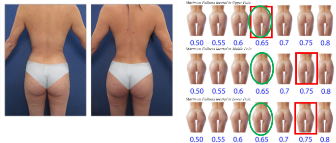 Optimizing Brazilian Buttock Lift Results Using the BBL Assessment Tool
