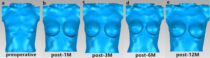 Breast Implants/Round Breasts - Concept - v1.0 - Reviewed by xrxlkool