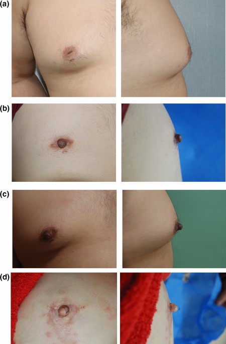 A New Method for Inverted Nipple Treatment with Diamond-Shaped Dermal Flaps  and Acellular Dermal Matrix: A Preliminary Study | Aesthetic Plastic Surgery