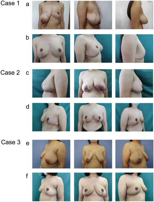 Three-Pedicle Reduction Mammaplasty Technique in the Treatment of Greater Breast  Hypertrophy Patients With or Without Breast Cancer: Surgical and  Patient-reported outcomes