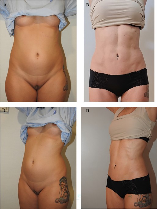 is lipo c safe From the SAFE to the SAFEST Liposuction: Combining PAL and RFAL Technology  in Body Contouring Procedures | Aesthetic Plastic Surgery