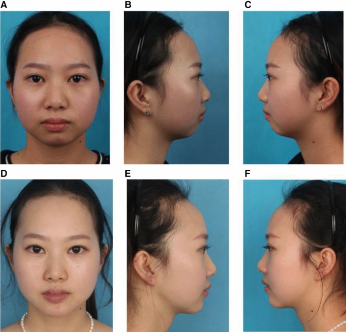 Correcting the Broad, Flat and Short Chin Using Modified M-genioplasty |  Aesthetic Plastic Surgery