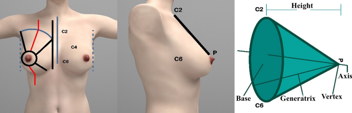 Calculation of pre-operative breast weight using Vectra XT 3D Face and