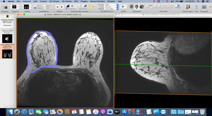 Assessment of Three Breast Volume Measurement Techniques: Single Marking,  MRI and Crisalix 3D Software®