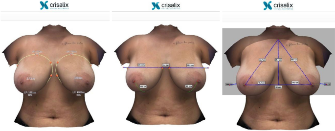 Assessment of Three Breast Volume Measurement Techniques: Single Marking,  MRI and Crisalix 3D Software®