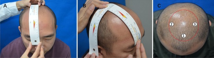 Injection of the Concentrate Derived from Nanofat Graft Promotes Hair Growth  in Patients of Male Androgenetic Alopecia: A Clinical Pilot Study |  Aesthetic Plastic Surgery