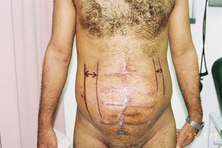A New Technique in Closure of Burst Abdomen: TI, TIE and TIES Incisions |  World Journal of Surgery
