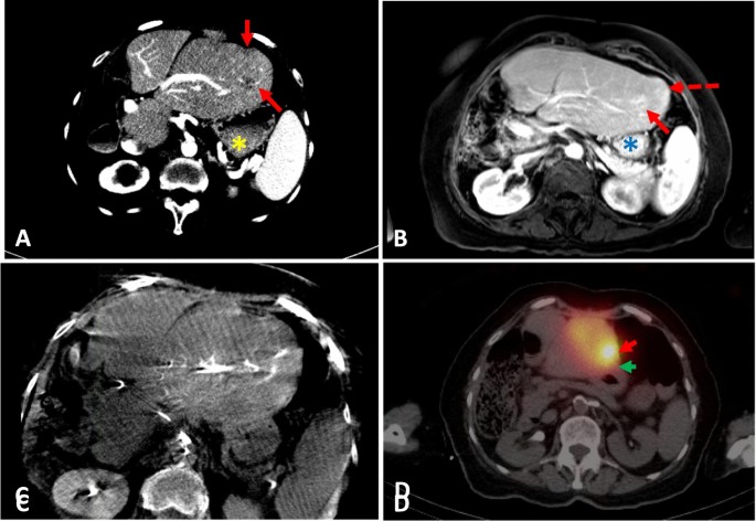 Radiation dose and incidence of new metastasis in the anterior