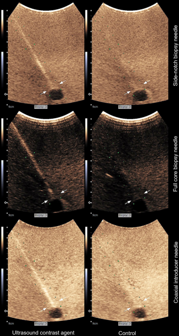 Needle bevel geometry influences the flexural deflection magnitude in  ultrasound-enhanced fine-needle biopsy