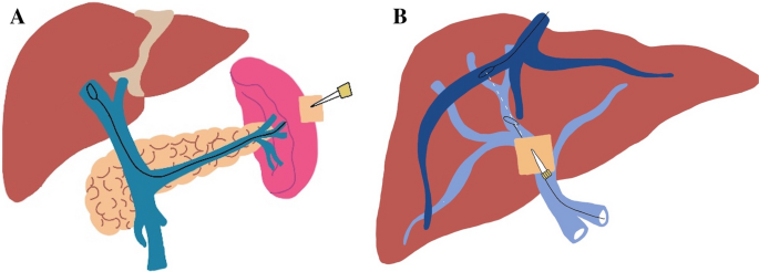 Safety and Feasibility of Gun-Sight Technique for Transjugular  Intra-hepatic Portosystemic Shunt (TIPS) Creation | CardioVascular and  Interventional Radiology