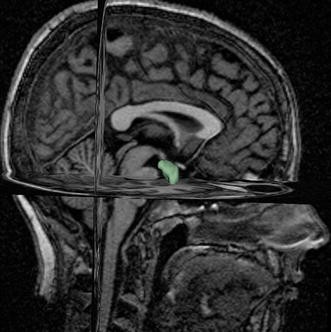 In vivo estimation of normal amygdala volume from structural MRI scans with  anatomical-based segmentation | Surgical and Radiologic Anatomy