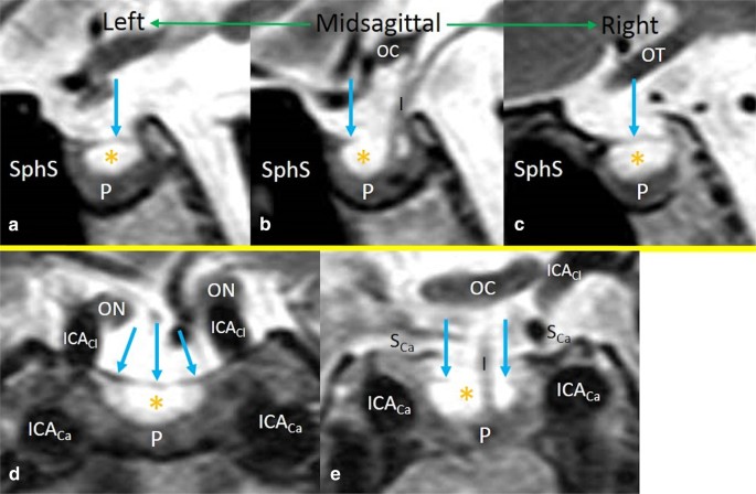 The diaphragma sellae, diaphragm opening, and subdiaphragmatic cistern: an  anatomical study using magnetic resonance imaging | Surgical and Radiologic  Anatomy
